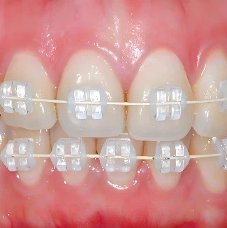 Parentesi dentali